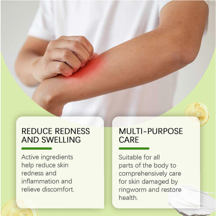 Eczema Treatment Cream